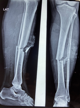 Fracture sustained in left tibia