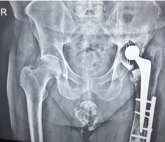Six months post plating periprosthetic fracture,  three months after Teriparatide