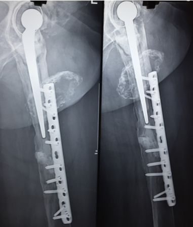 Twelve months post plating periprosthetic fracture, after nine months after Teriparatide