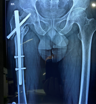 Atypical fracture femur, nine months post-operative after four months of Teriparatide