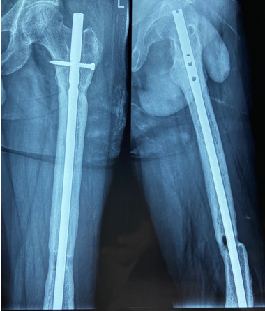 Thirteen months post-operative after six months of Teriparatide