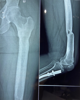 Femoral nail removed eighteen months post-operative with continued Teriparatide