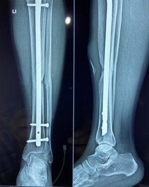 Eighteen months post-operative with continued Teriparatide