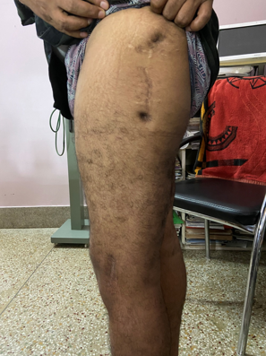 Wound heald eighteen months post-operative