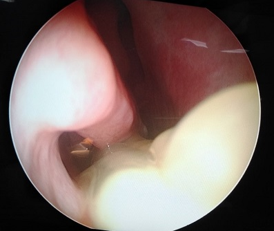 CRS sans nasal polyposis