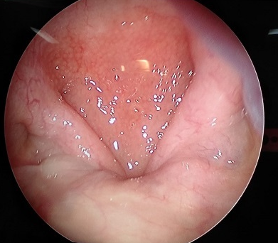 Retroplatal obstruction grade 4