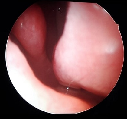 Deviated nasal septum
