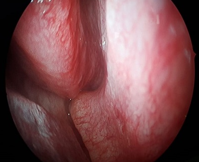 Septal spur to right 