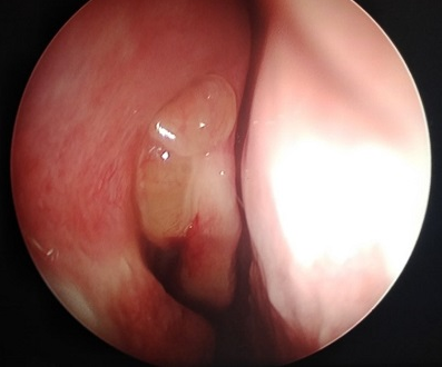 CRS with nasal polyposis