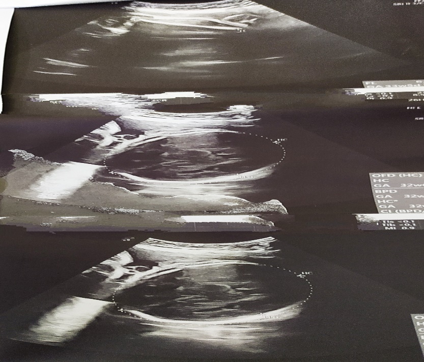 TAS abdomen showing single live intrauter inefetus with dilated small bowel loops