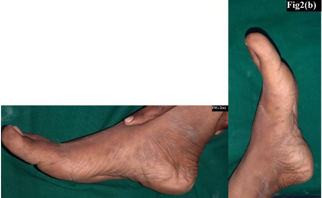 2(a): Multiple ill-defined bilaterally symmetrical, hyperpigmented, discrete round macules of size 5-10 mm over medial border of right foot, 2(b): multiple ill-defined bilaterally symmetrical, hyperpigmented, discrete round macules of size 5-10 mm over medial border left foot 