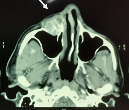 CECT showing heterogeneously enhancing lesion with multiple hyperdense septation in the anterior wall of right maxillary sinus