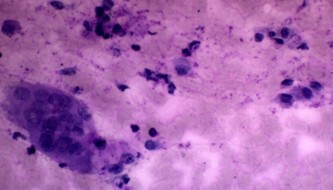 FNAC image showing multinucleated giant cell and mononuclear cells (x40, Leishman)