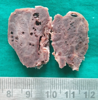Grey brown mass with tiny cysts and thin bony septae in between