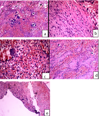 a: clustering of giant cells around hemorrhage (x10,H&E); b: bland spindle cells (x40,H&E); c: mononuclear stromal cells (x40,H&E); d: osteoid/reactivebone formation (x20,H&E); e: aneurysmal bone cyst like area (x10,H&E)