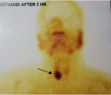 MIBI avid lesion near lower pole of right lobe of thyroid