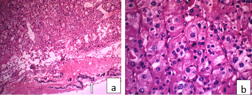 a: neoplasm with periphery showing parathyroid tissue(x10,H&E); b: nests of chief cells surrounded by thin vasculature (x40,H&E)