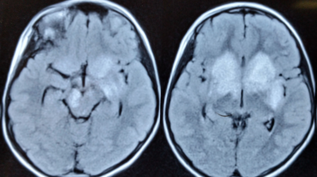 Axial Fluid attenuated inverse recovery sequence of brain magnetic resonance imaging showing hyperintensities in bilateral basal ganglia, right side of midbrain and left basi-frontal and left basi-temporal lobe. 