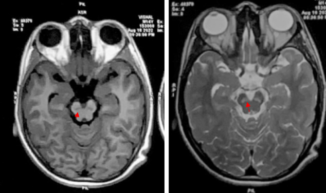 AxialT1 and T2 weighted magnetic resonance imaging of brain show substantia nigra hypointensity and hyperintensity respectively suggesting degeneration and gliosis.(red arrows)
