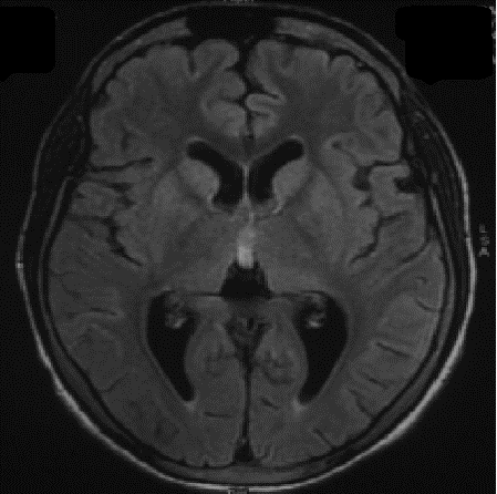 Axial FLAIR magnetic resonance imaging of brain showing hyperintensities in bilateral basal ganglia and thalamus. 