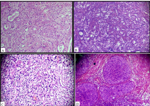 A: Photomicrograph of Adenocarcinoma-Gleason‘s grade 2 (10x). B: Photomicrograph of Adenocarcinoma- Gleason‘s grade 3(10x). C: Photomicrograph of Adenocarcinoma-Gleason‘s grade 5(10x). D: Photomicrograph of Invasive Urothelial carcinoma (10x).