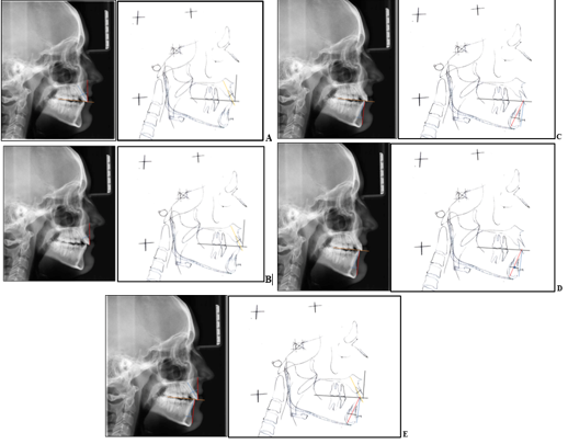 (a): Maxillary central incisor root position (b): Maxillary alveolar process thickness (c): Mandibular central incisor root position (d): Mandibular alveolar process thickness (e): Incisor inclination (U1 & L1)