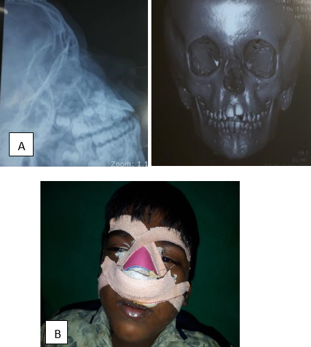 A: X-ray and CT showing nasal bone fracture; B: Moulding and closed reduction were done.