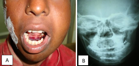 A: Right Para symphyseal fracture with sublingual hematoma; B: MMF with mandibular plating