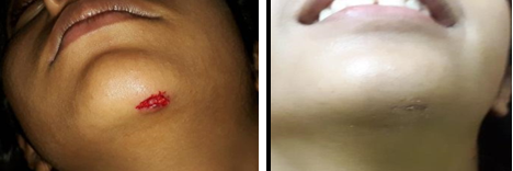 Soft tissue injury in the chin