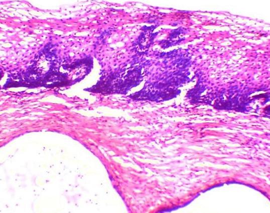 Photomicrograph of CIN 1(10X, H& E stain)