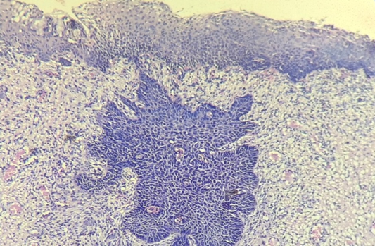 Photomicrograph of moderately differentiated squamous cell carcinoma (40X, H&E stain)