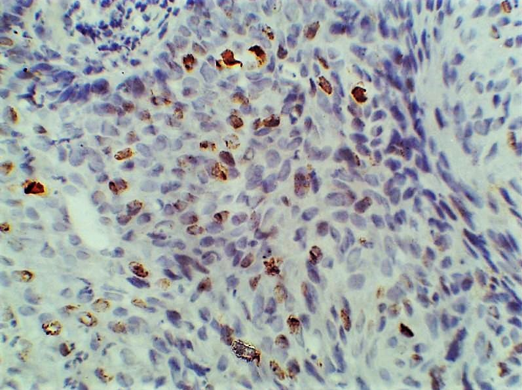 Photomicrograph of moderately differentiated squamous cell carcinoma (40X, ki-67 stain)