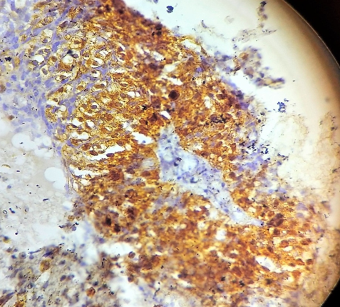 Photomicrograph of moderately differentiated squamous cell carcinoma (40X, p16 stain)