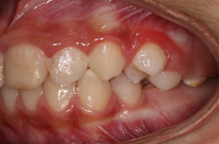 Initial left lateral intraoral photograph