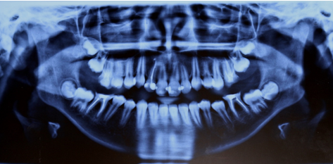 Initial panoramic radiograph