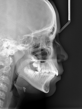 Initial cephalometric radiograph