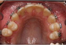 Upper occlusal intraoral photograph with fixed appliance