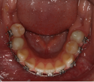 Lower occlusal intraoral photograph with fixed appliance