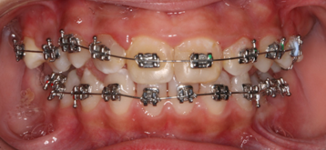 Frontal intraoral photograph with fixed appliance