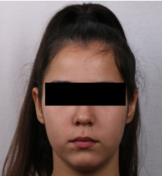 Final frontal photograph