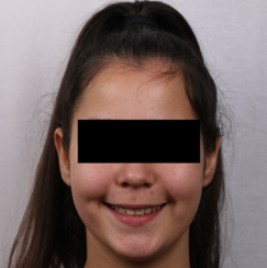 Final frontal photograph with a smile