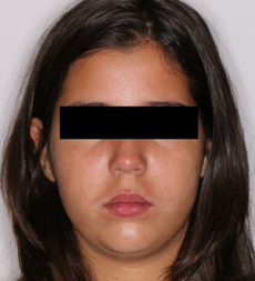 Initial frontal photograph