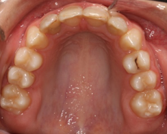Final upper occlusal intraoral photograph