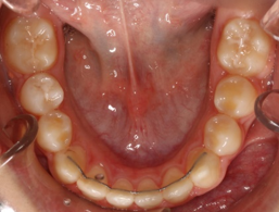 Final lower occlusal intraoral photograph