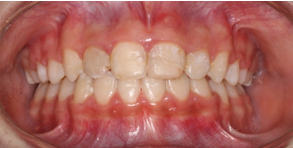 Final frontal intraoral photograph