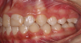 Final left lateral intraoral photograph