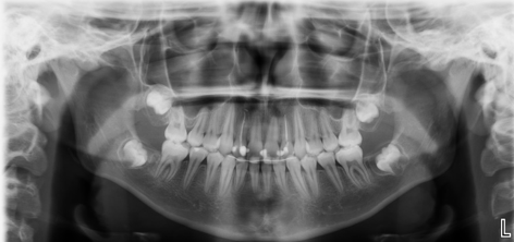 Final panoramic radiograph
