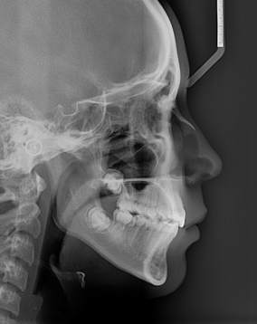 Final cephalometric radiograph