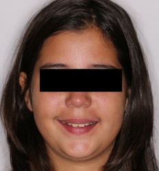 Initial frontal photograph with a smile