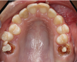 Initial upper occlusal intraoral photograph